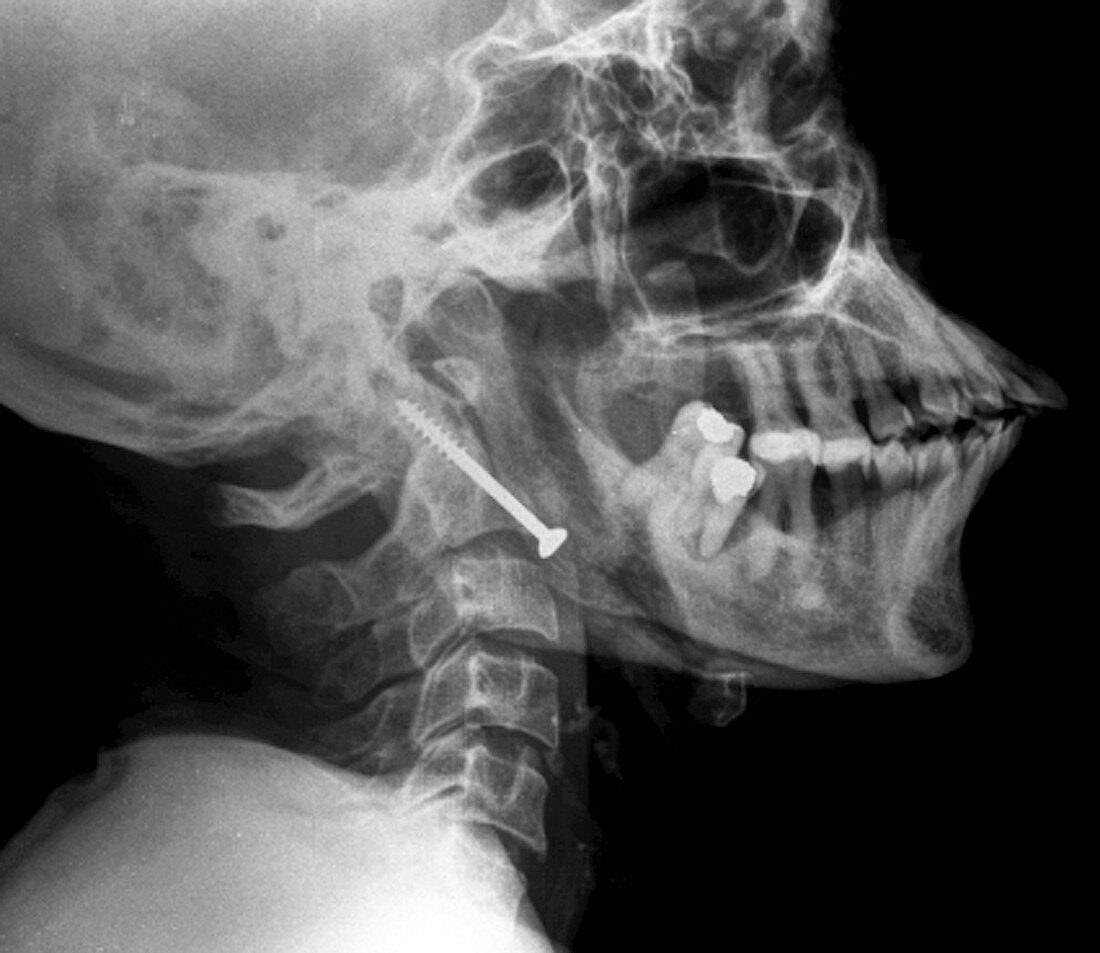 Pinned broken neck,X-ray