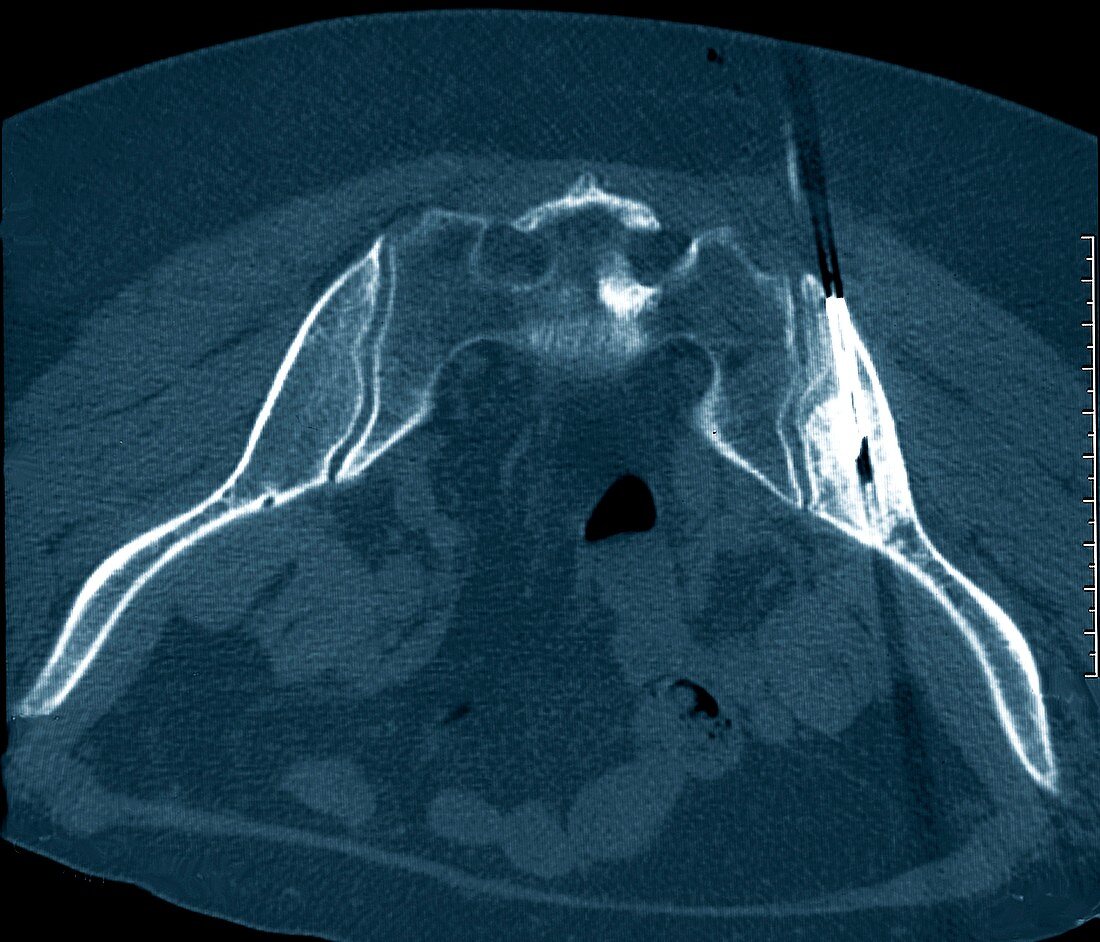 Secondary pelvic cancer being treated,CT