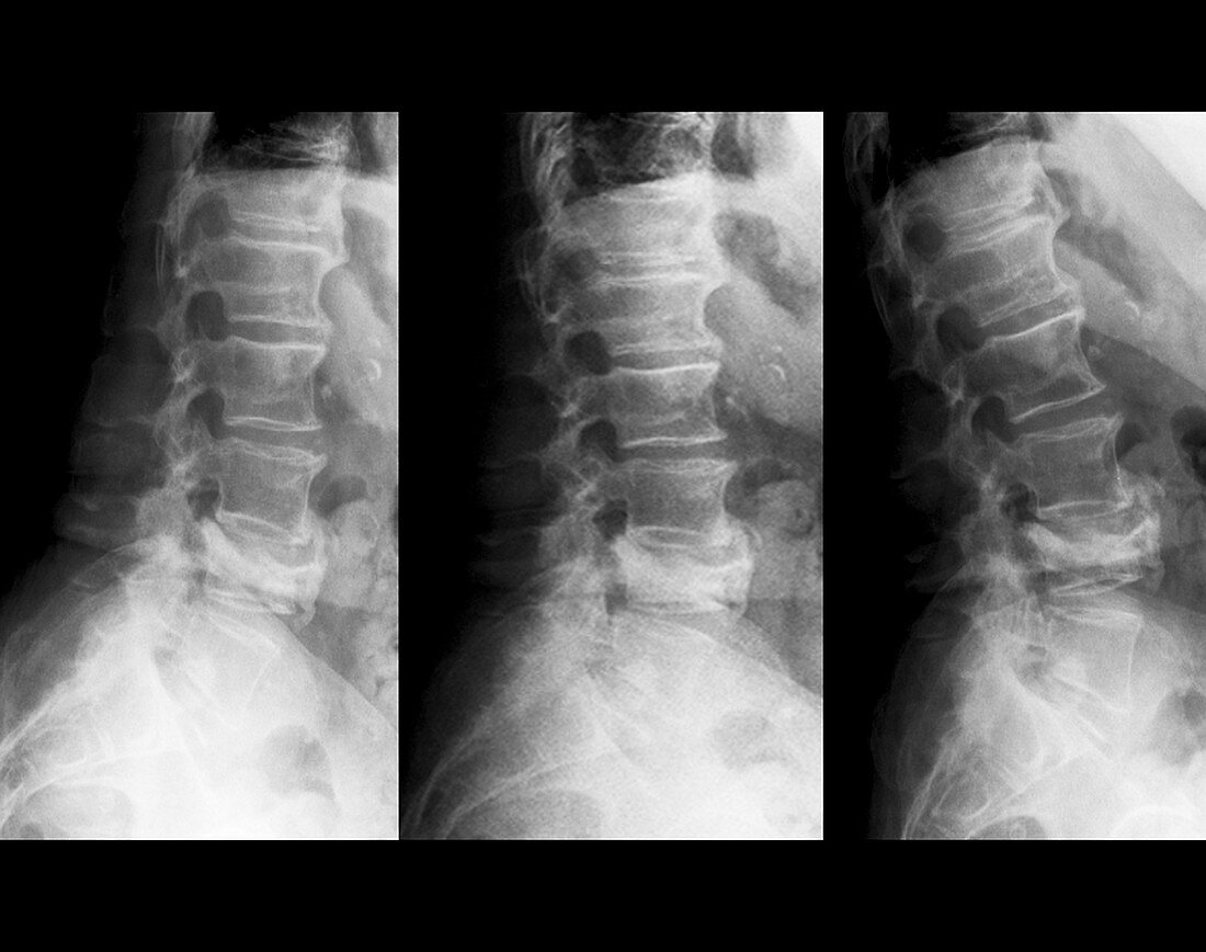 Spinal compression fractures,X-ray