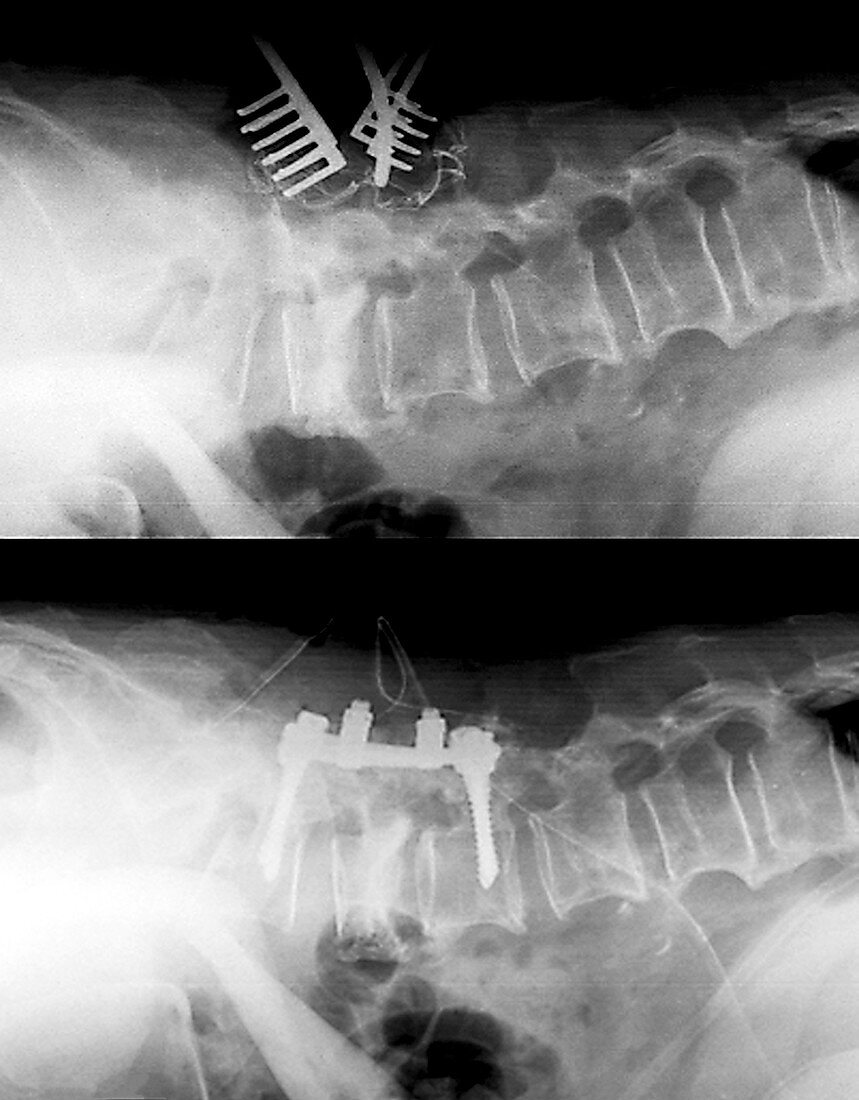 Spinal compression fractures in surgery