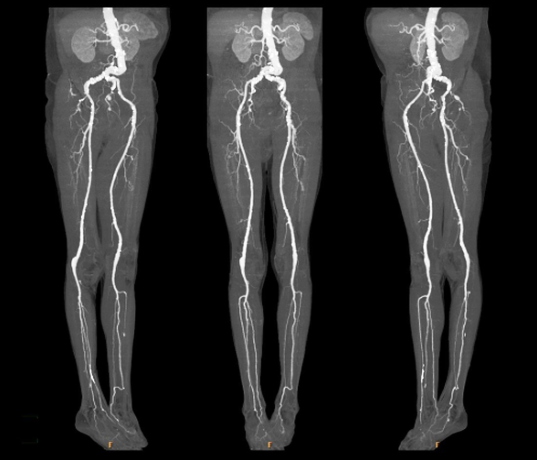 Arterial aneurysm,X-ray
