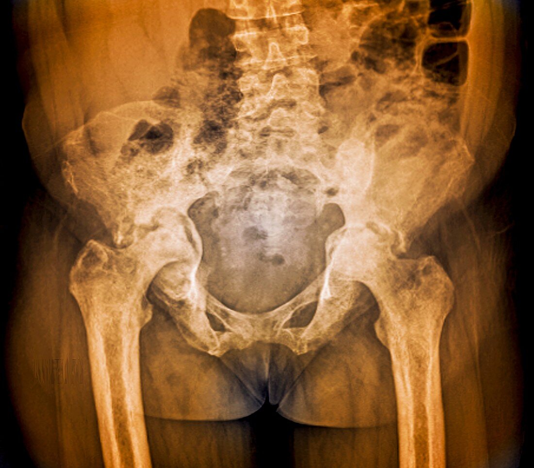 Osteonecrosis of the hip,X-ray