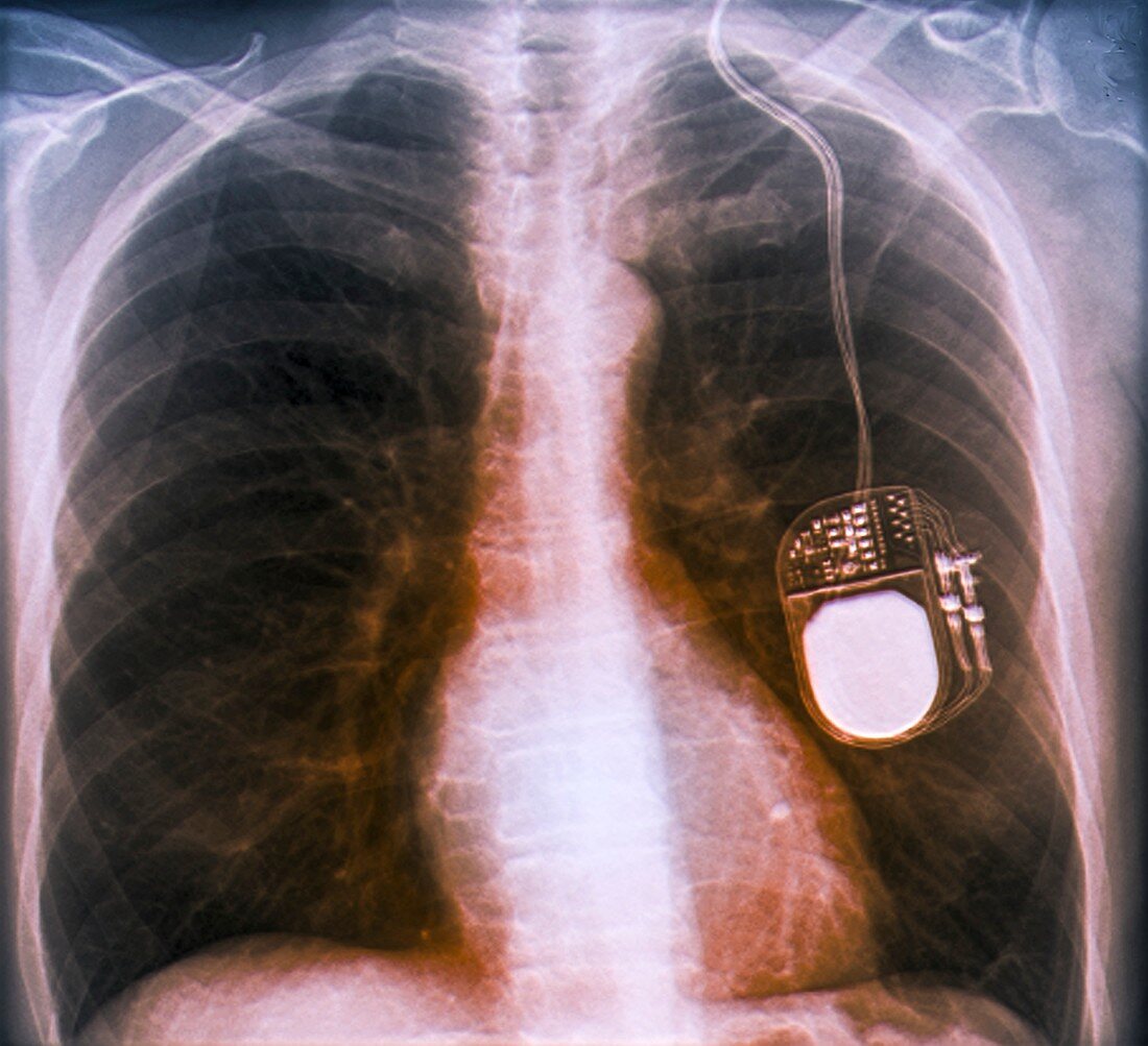 Parkinson's brain pacemaker,X-ray