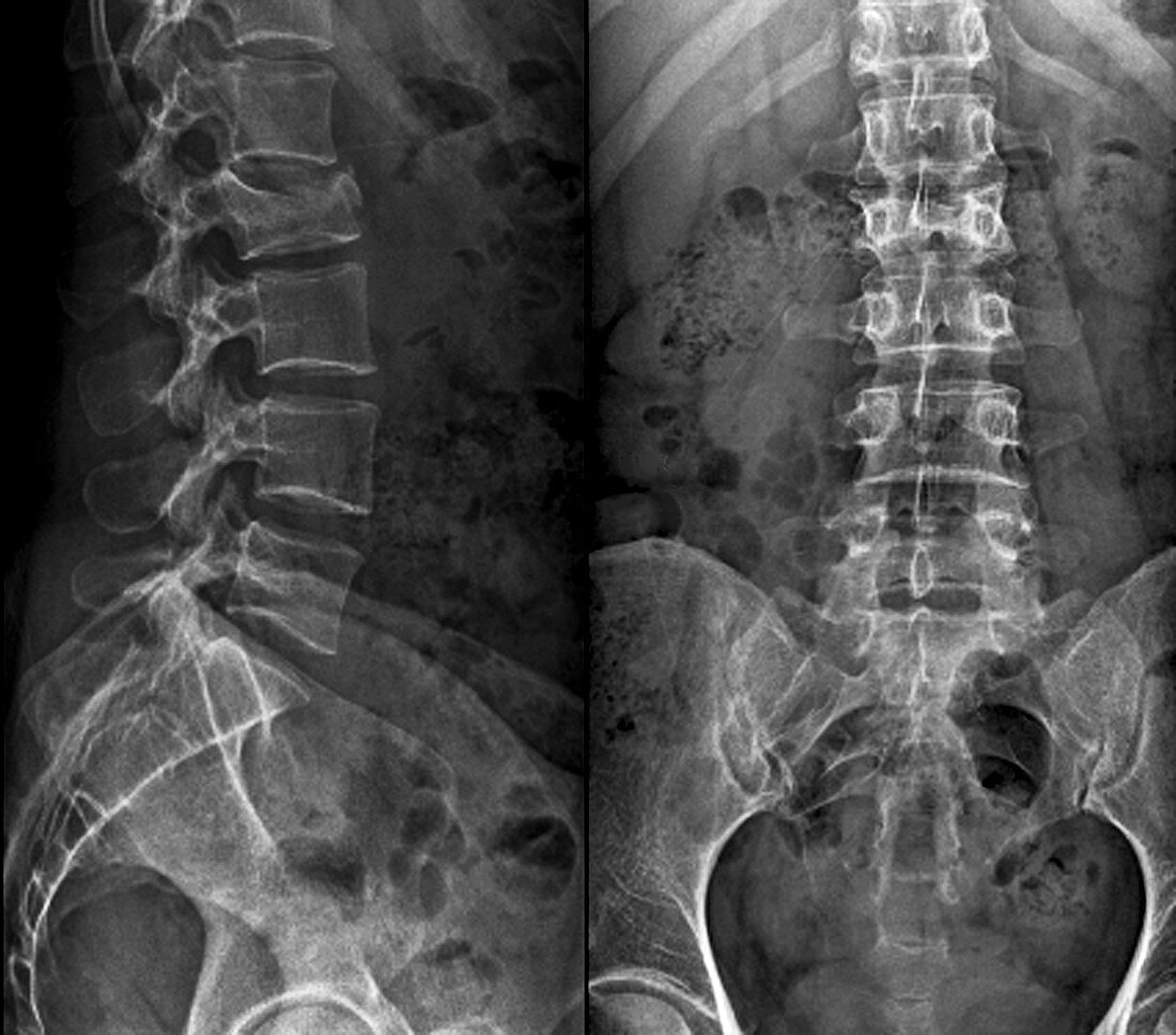 Untreated fractured vertebra,X-ray