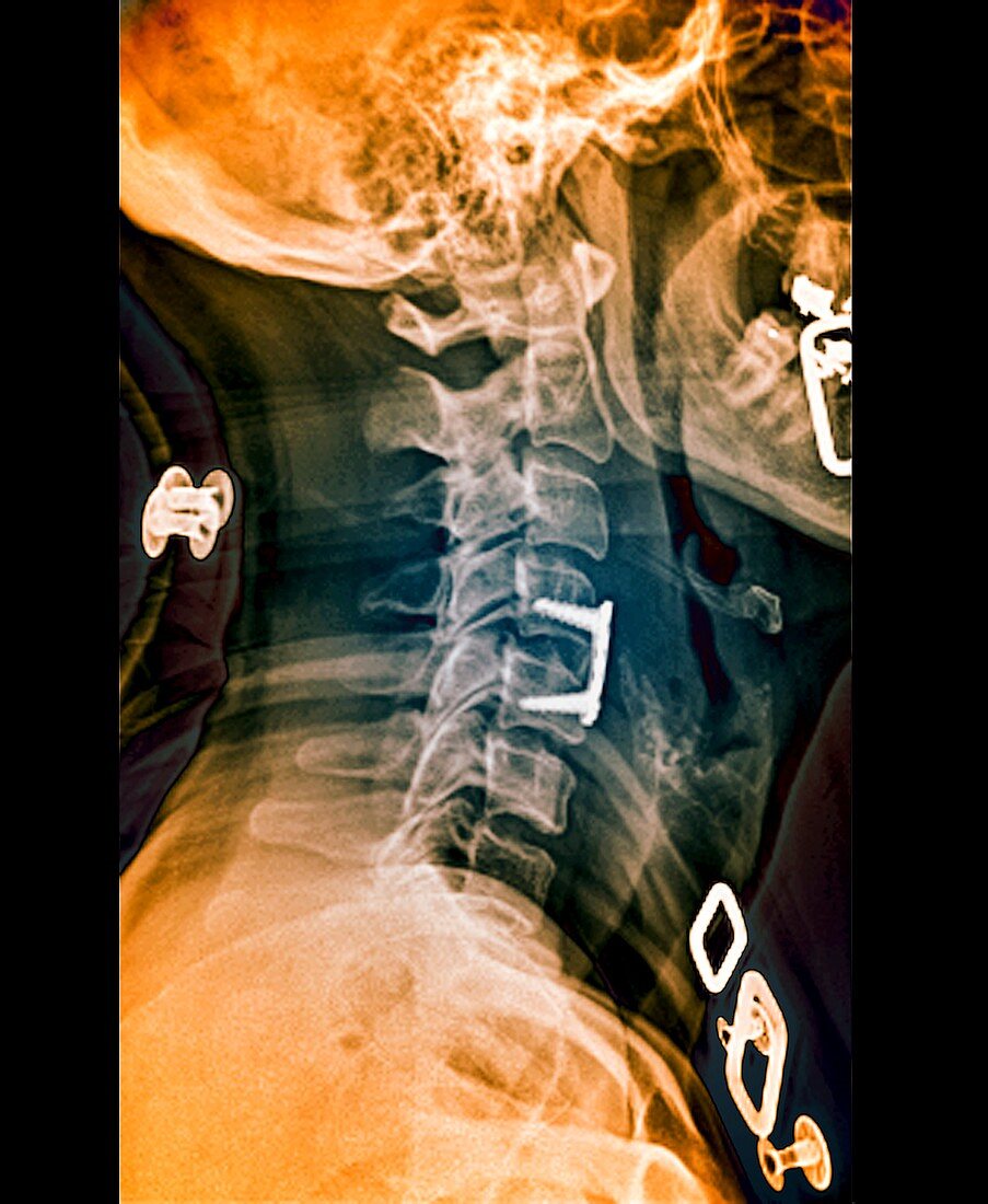 Herniated spinal disc after treatment
