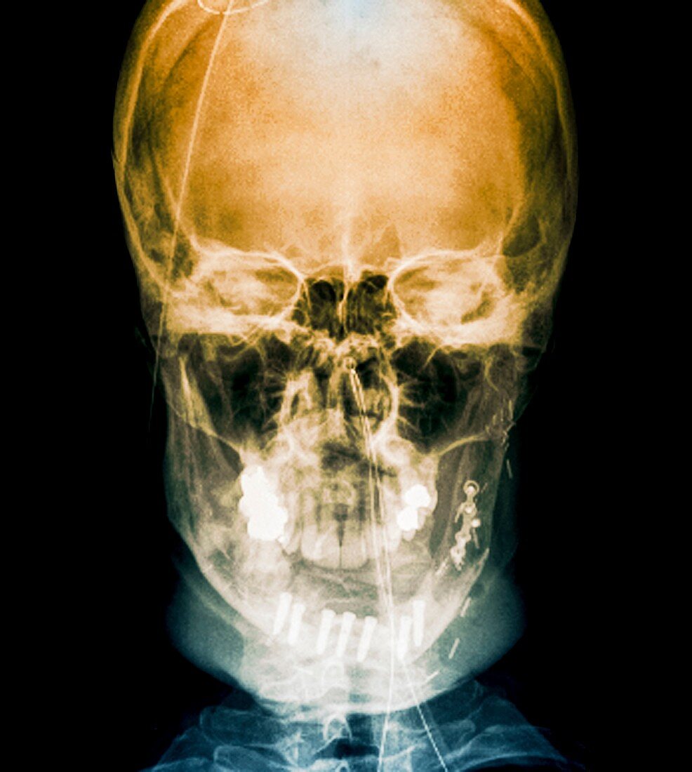 Road accident facial trauma,X-ray