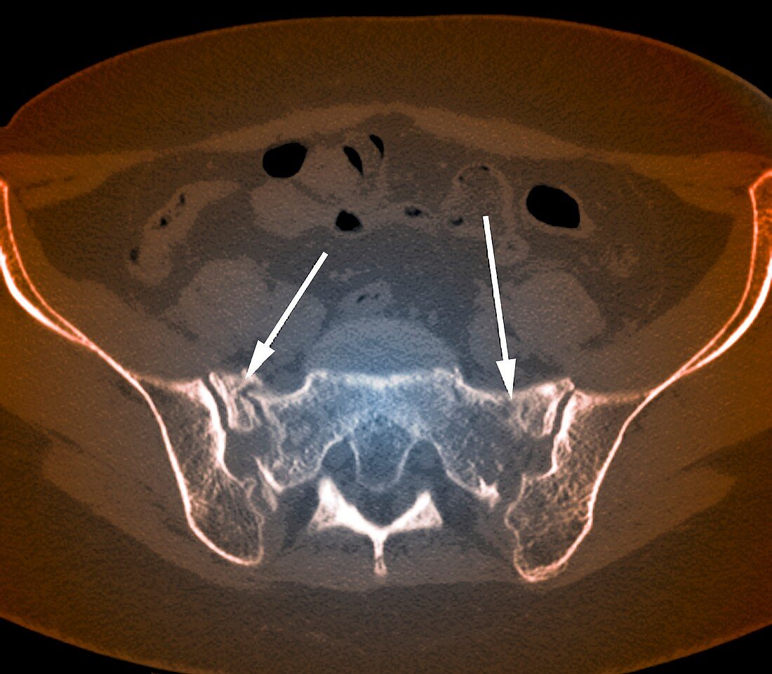 Fractured pelvis,CT scan