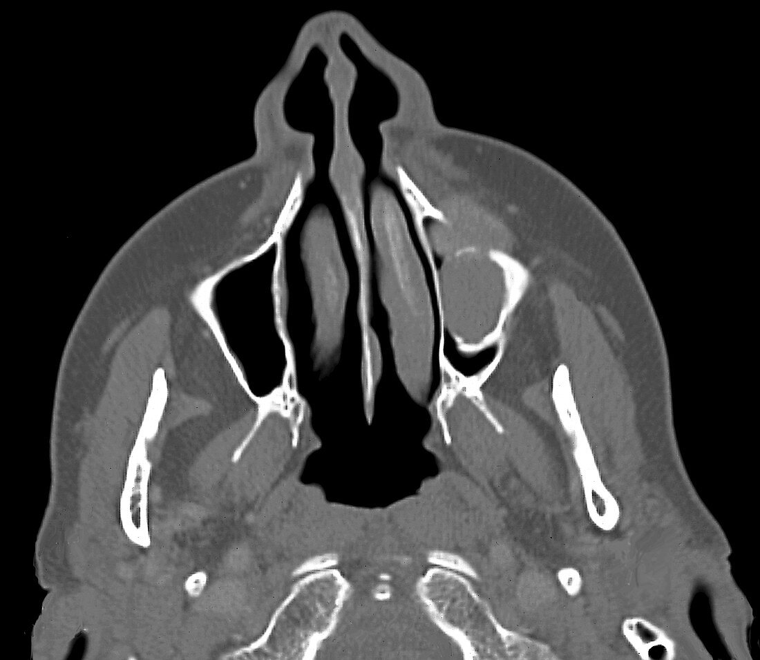 Giant cell granuloma of the jaw,CT scan