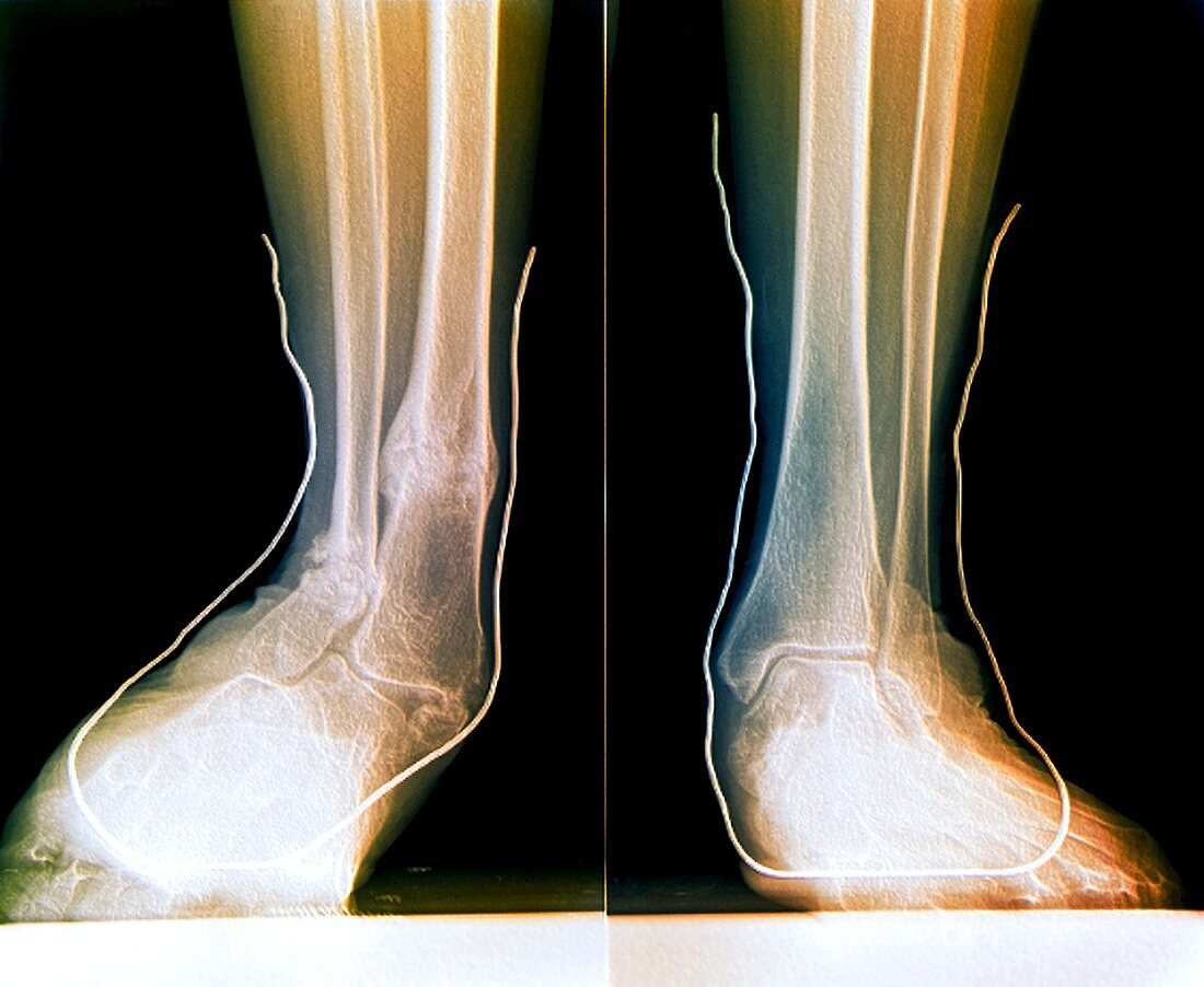 Flat feet with supports,X-ray