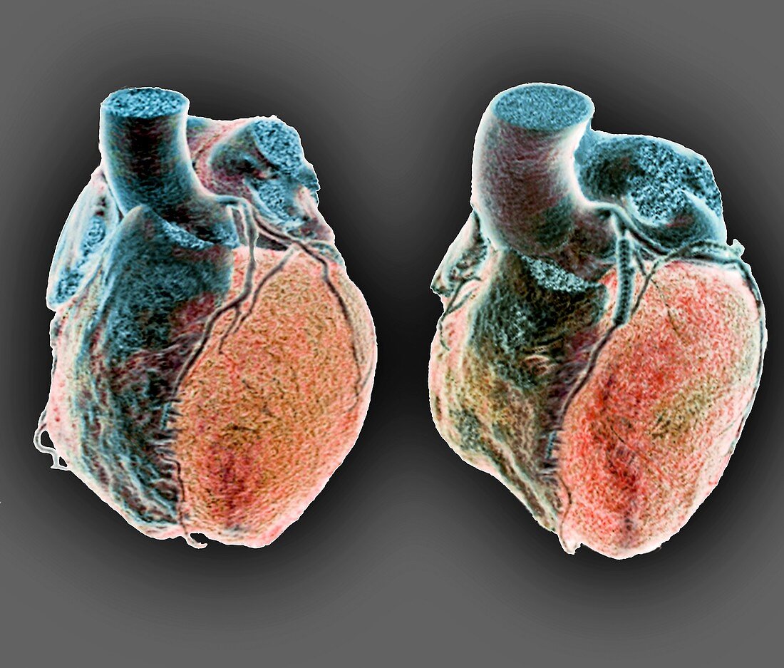 Coronary stent,3D CT scans