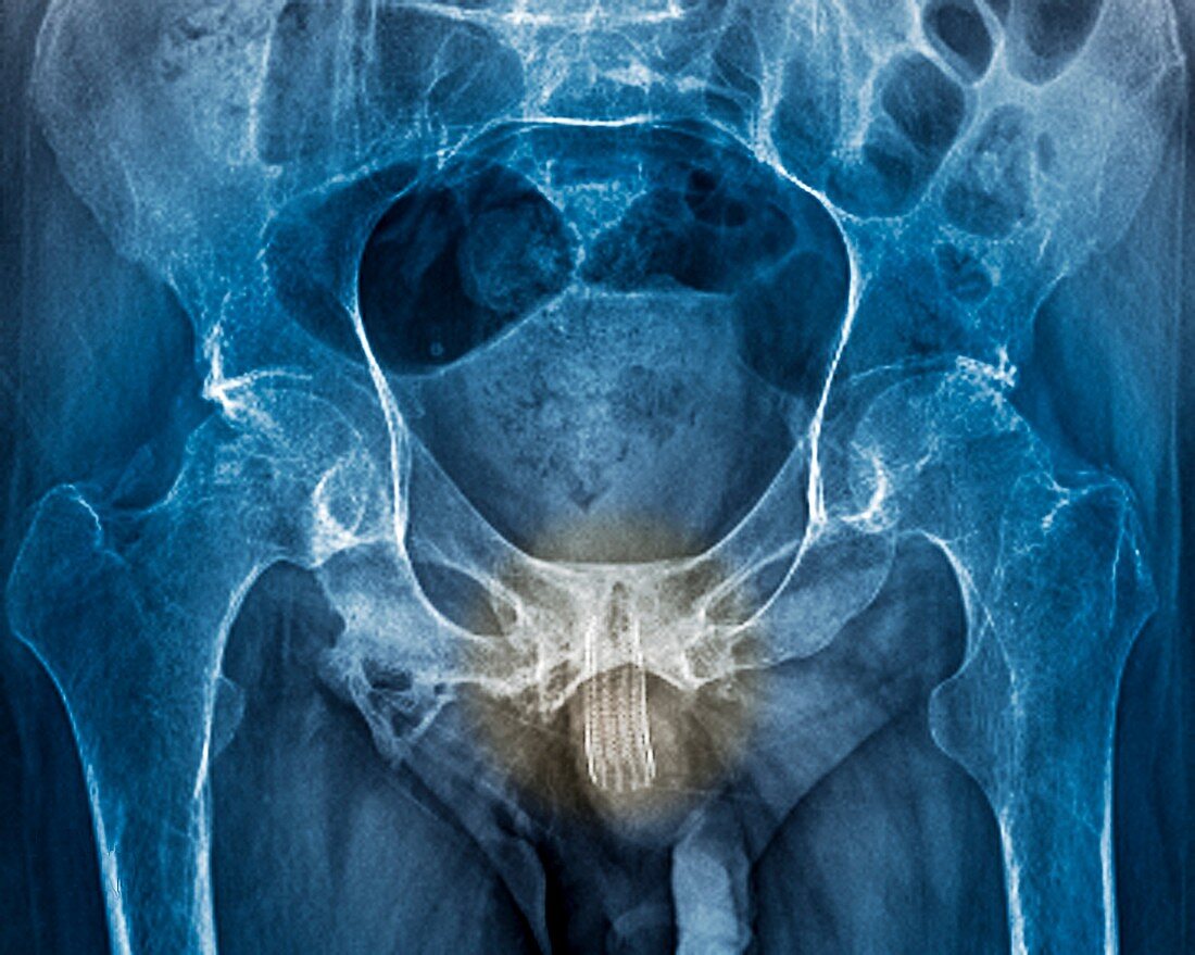 Urethral stent,Xray
