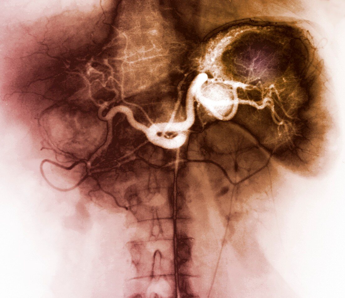 Spleen abscess,X-ray