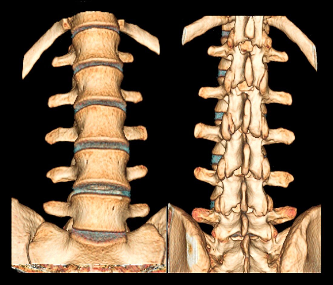 Normal spine,3D CT scans
