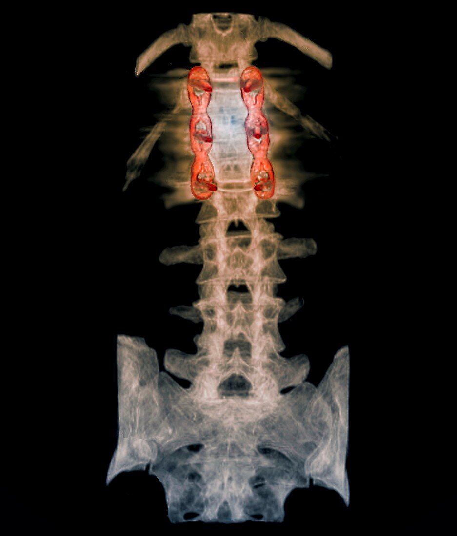 Pinned spinal fracture,X-ray