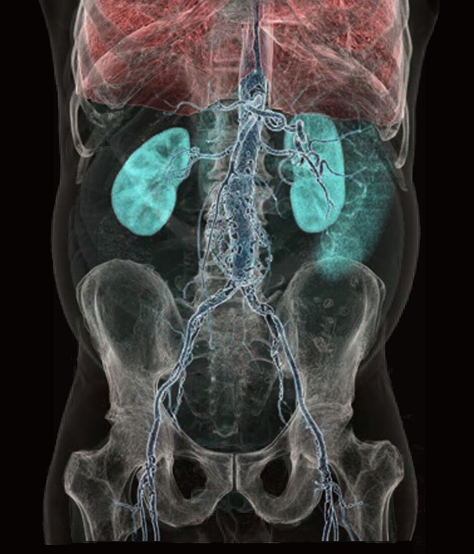 Aortic atheromas,3D CT scan