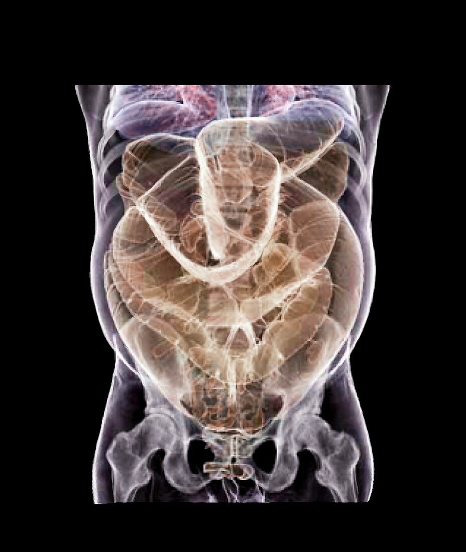 Abnormally large intestine,3D CT scan