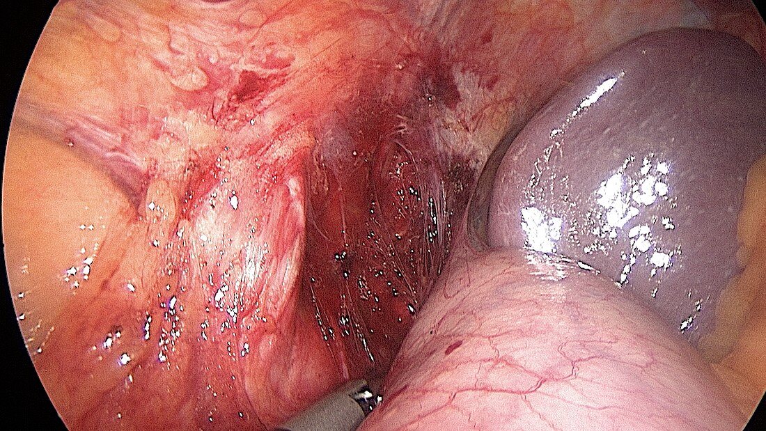 Endoscope view of abdominal surgery