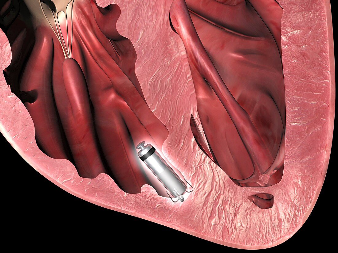 Leadless pacemaker in anterior heart
