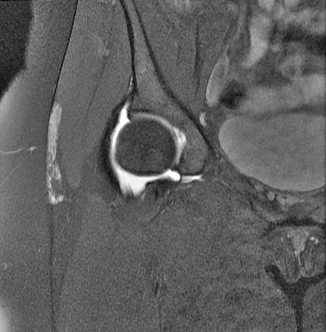 Hip MRI showing Hemangioma