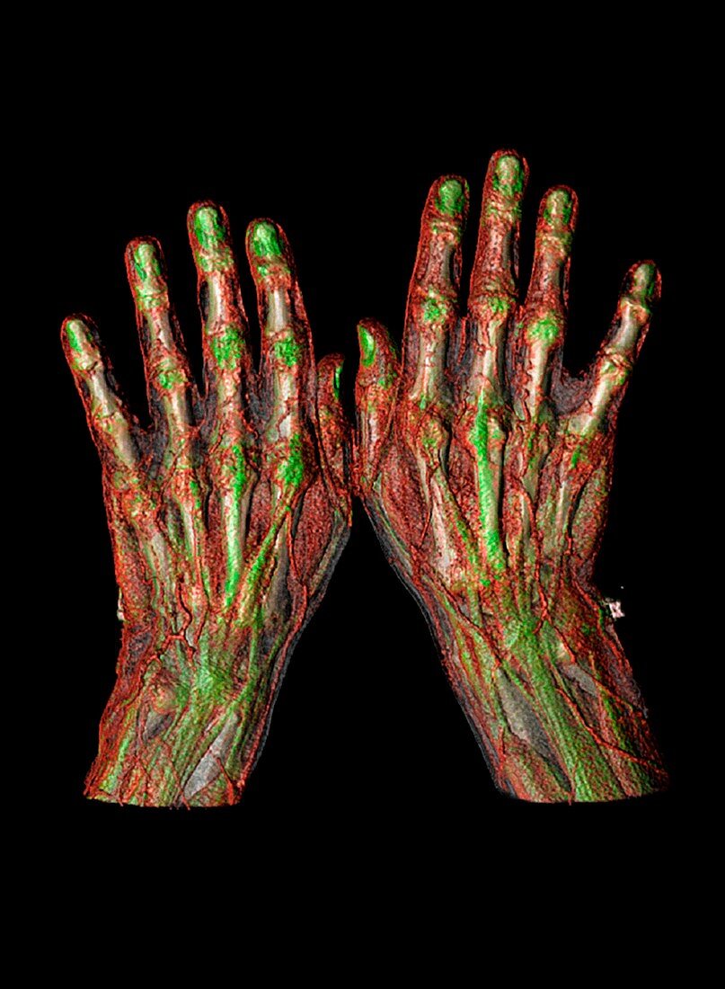 Human hands,CT scan