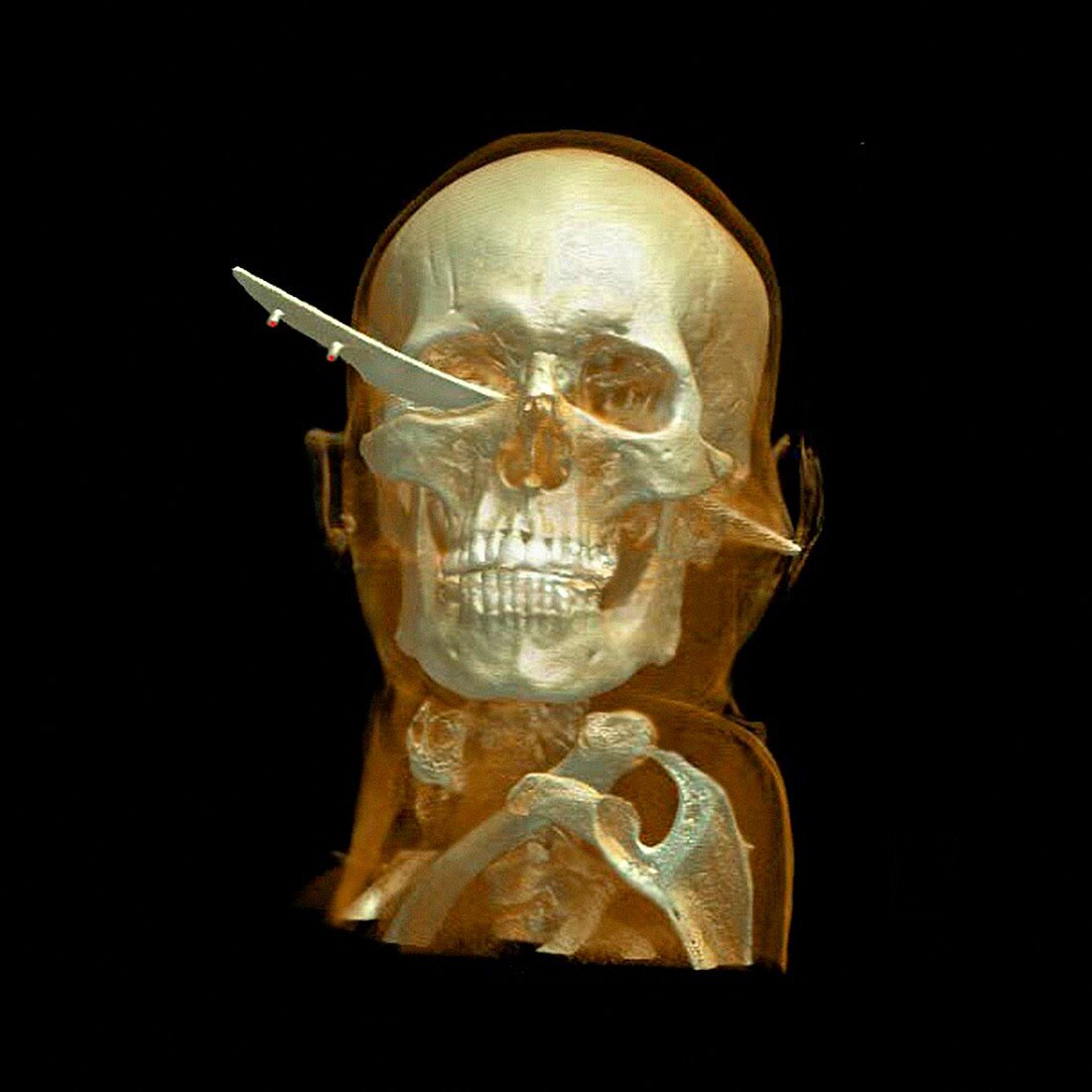 Knife skull injury,CT scan