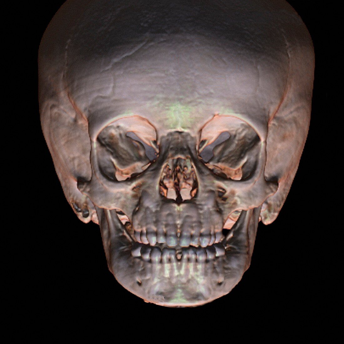 Human baby's skull,CT scan