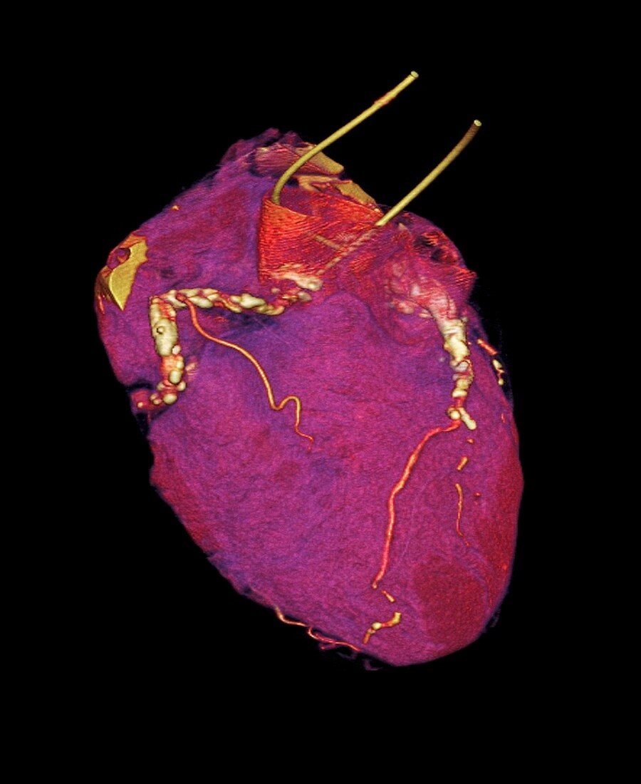 Human heart,CT scan