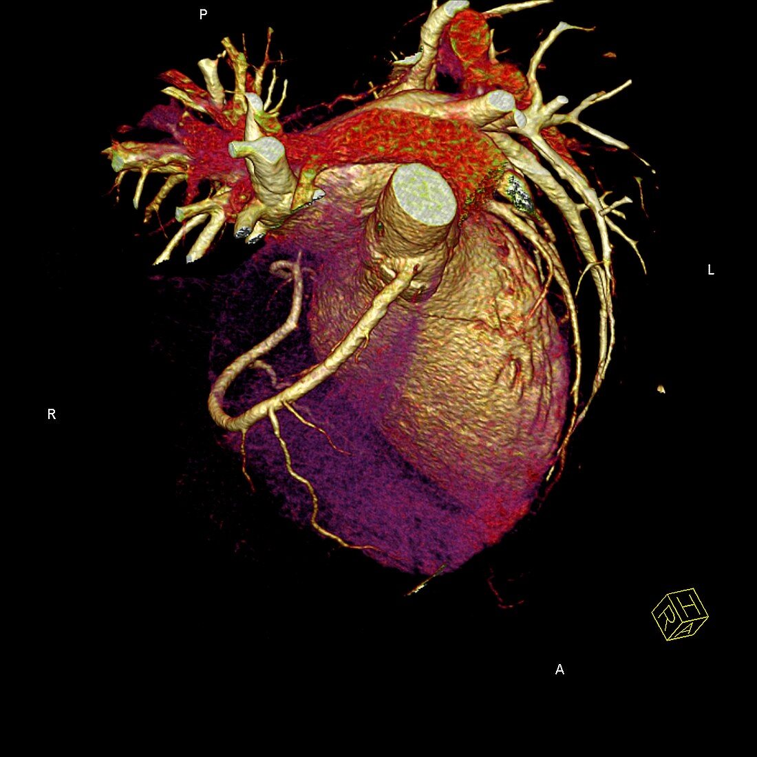 Human heart,CT scan