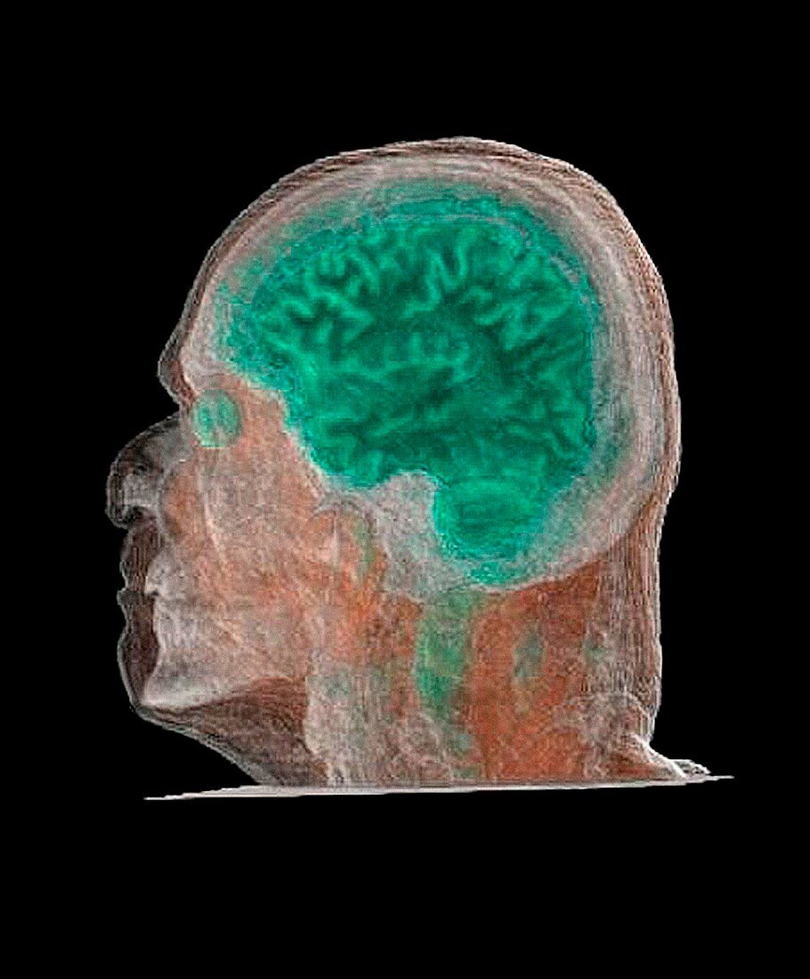 Human head and brain,CT scan