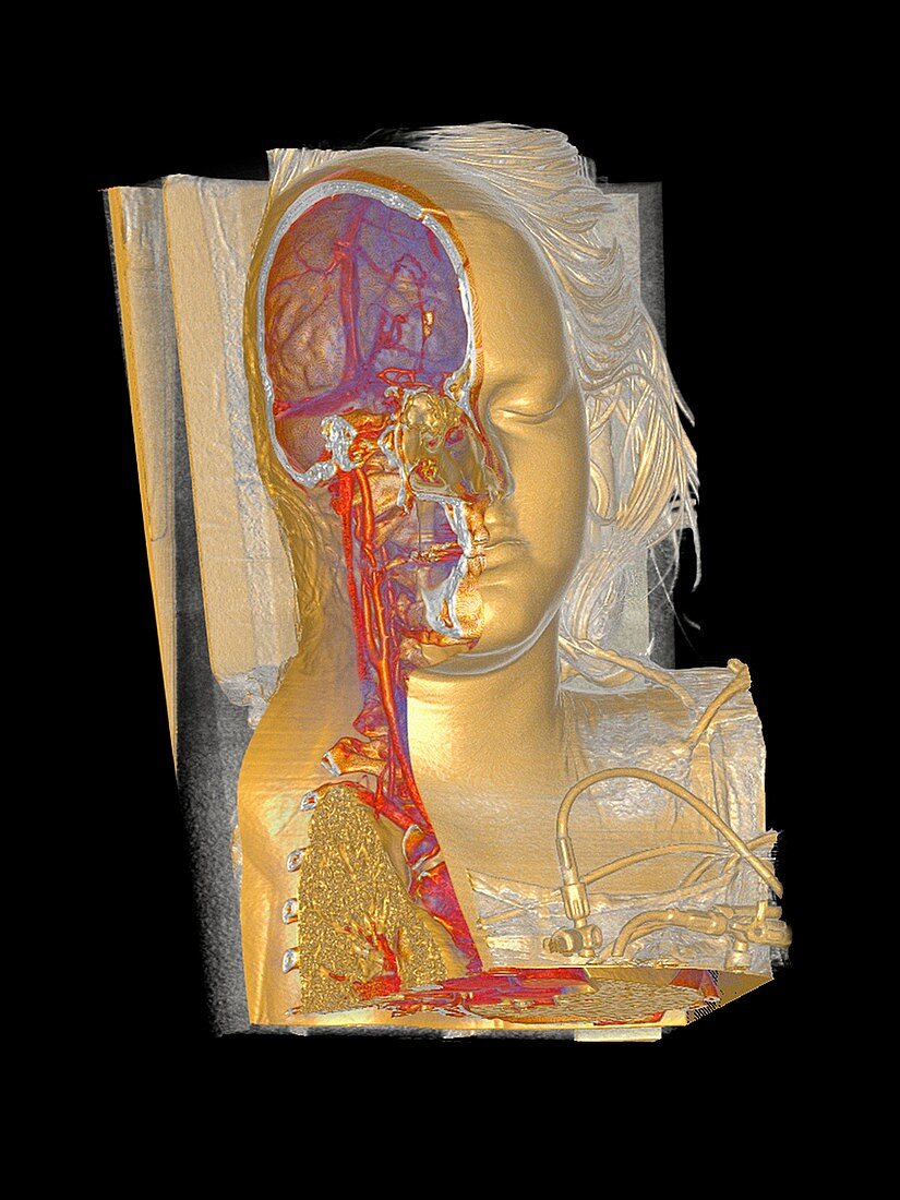 Human head and chest,CT scan