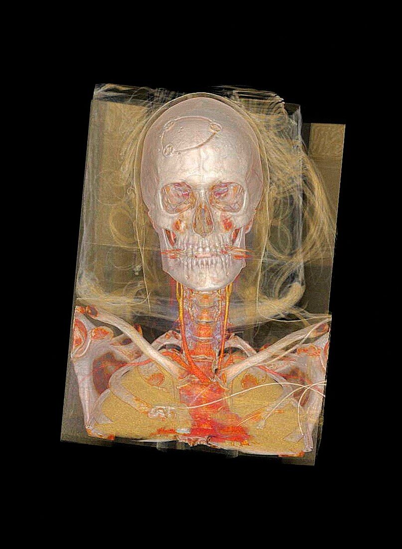 Human skull and chest,CT scan