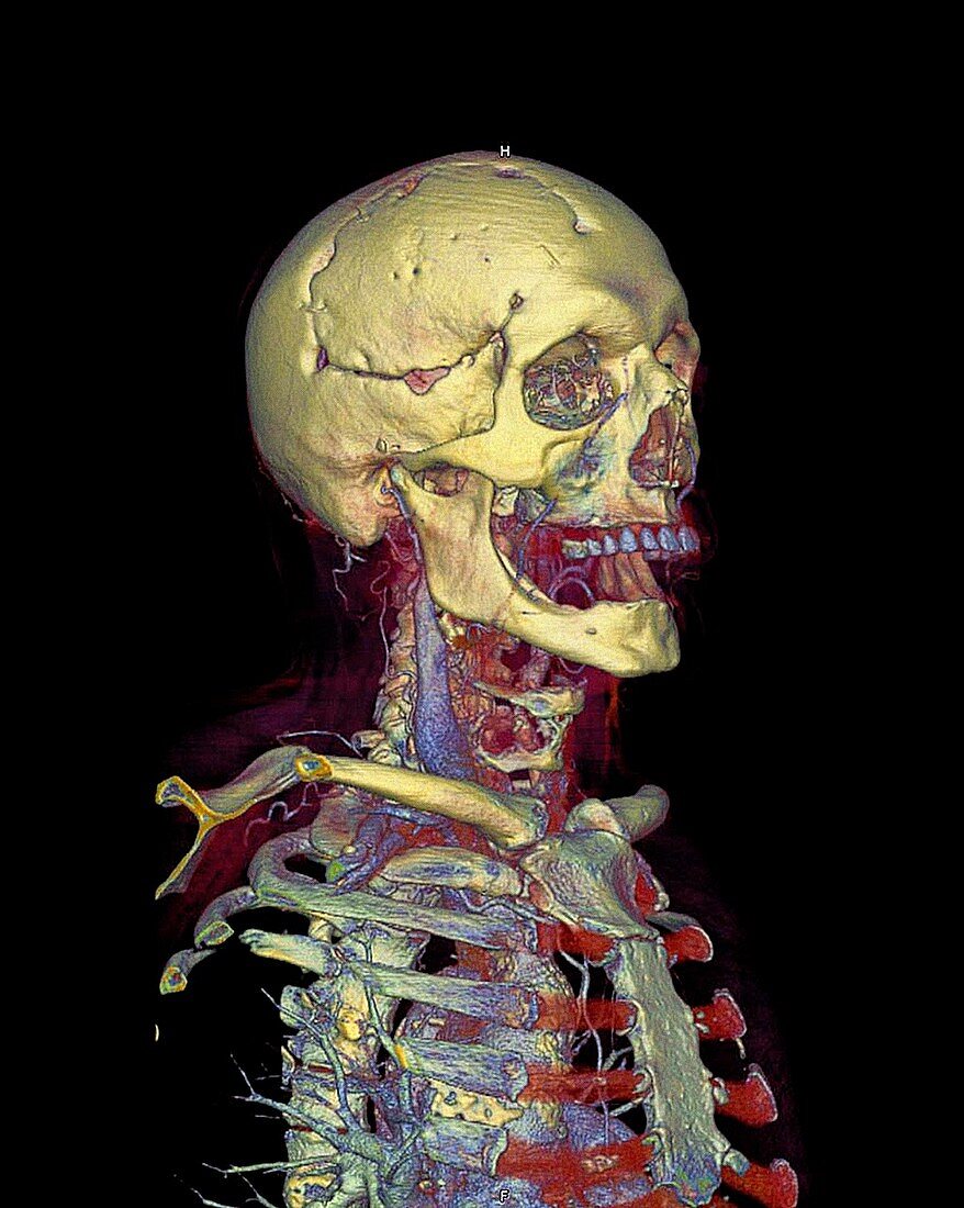 Human skull and chest,CT scan