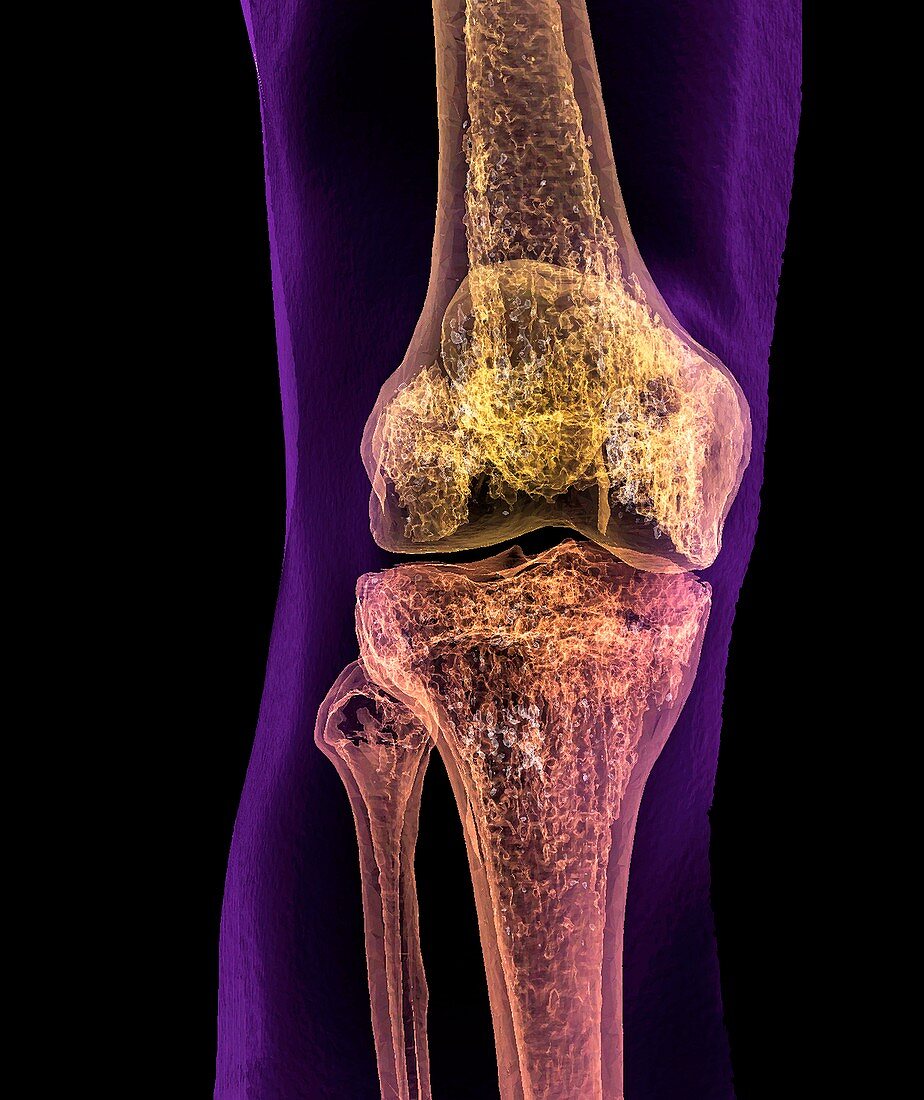 Normal adult knee,CT scan