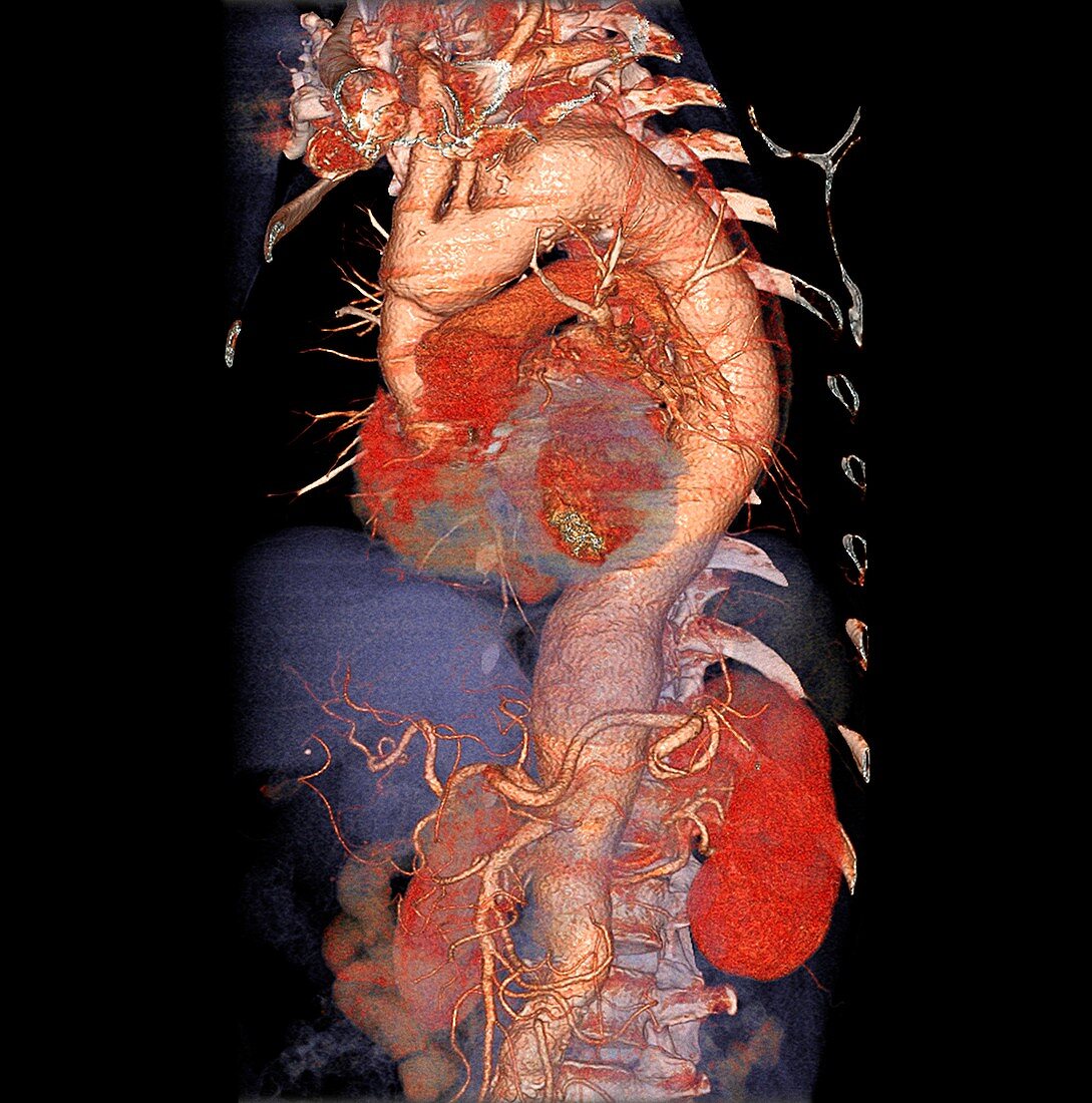Enlarged aorta,CT scan