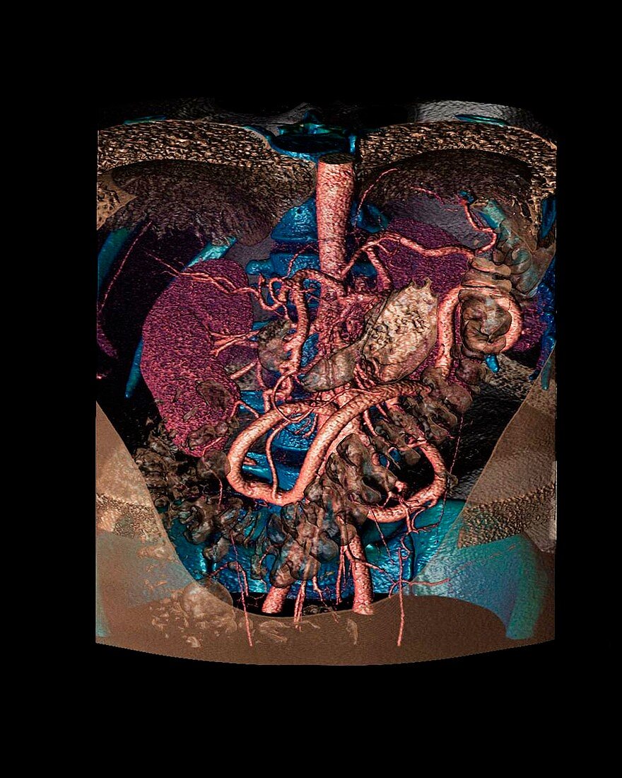 Distended mesenteric artery,CT scan