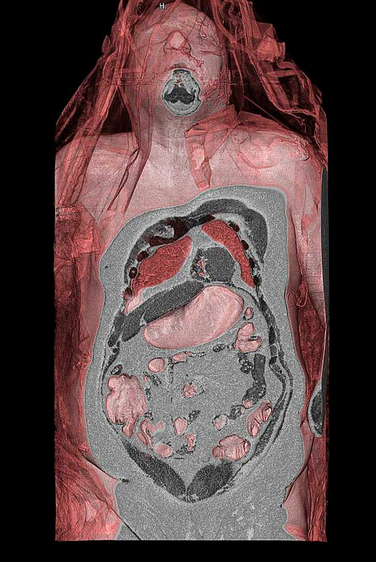 Trapped abdominal gas,CT scan