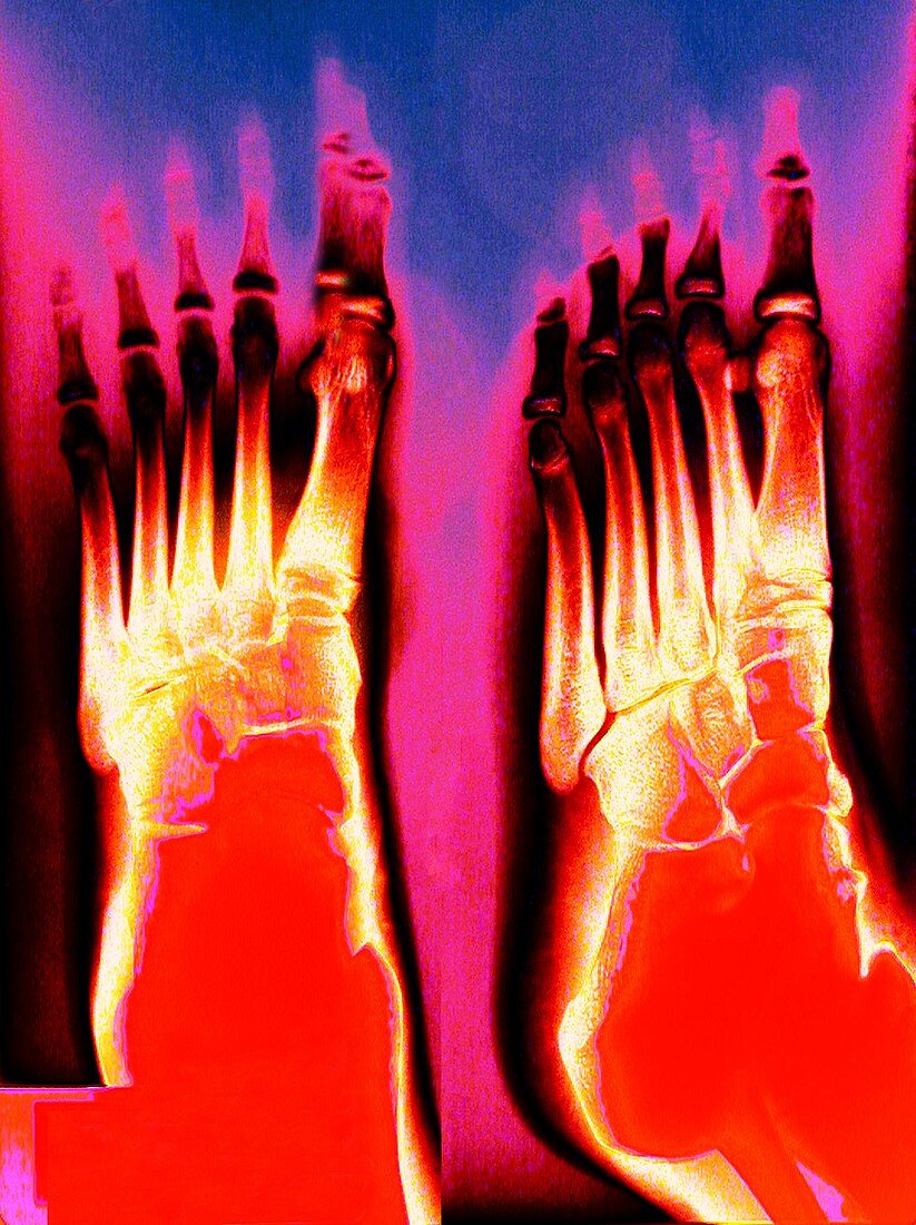 Feet,coloured X-ray