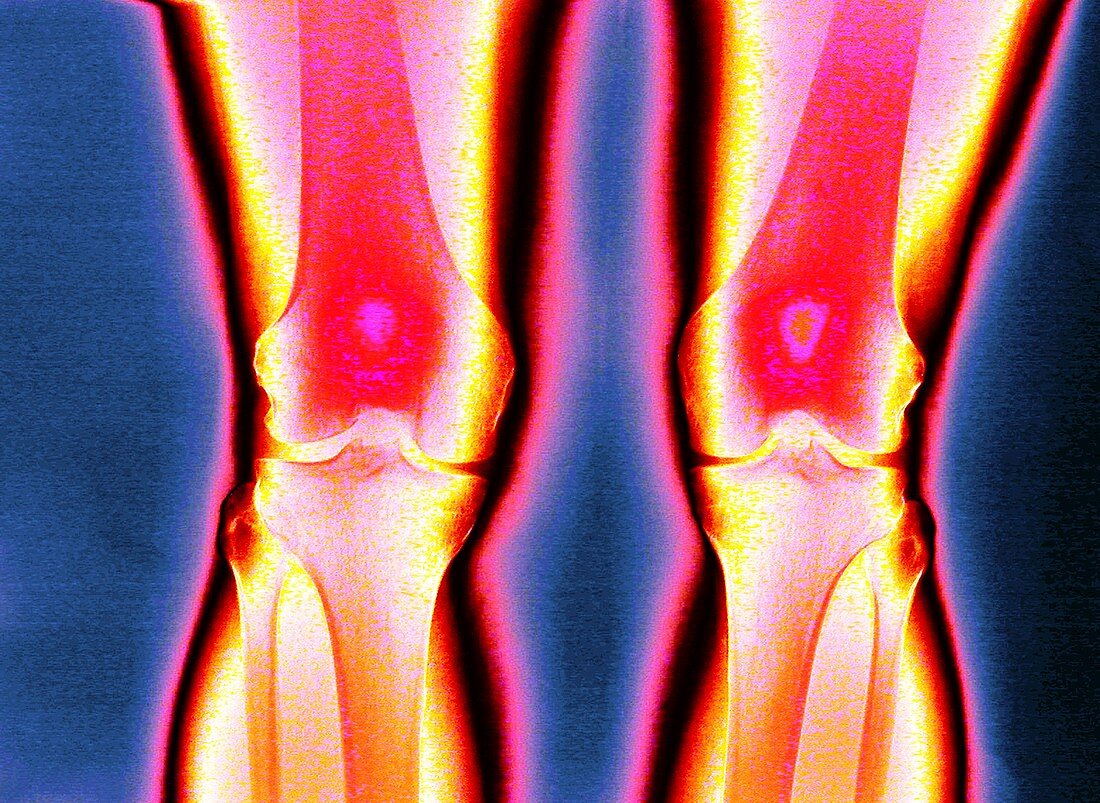Knees,coloured X-ray