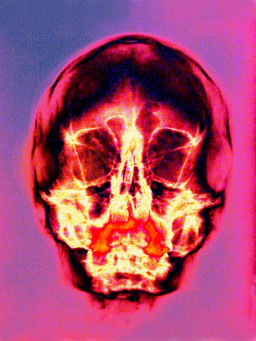 Skull,coloured X-ray