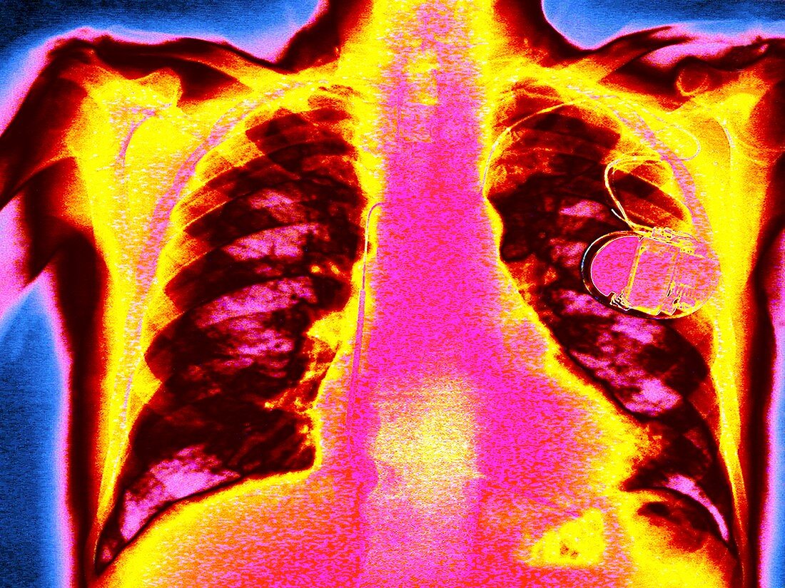 Defibrillator,coloured chest X-ray