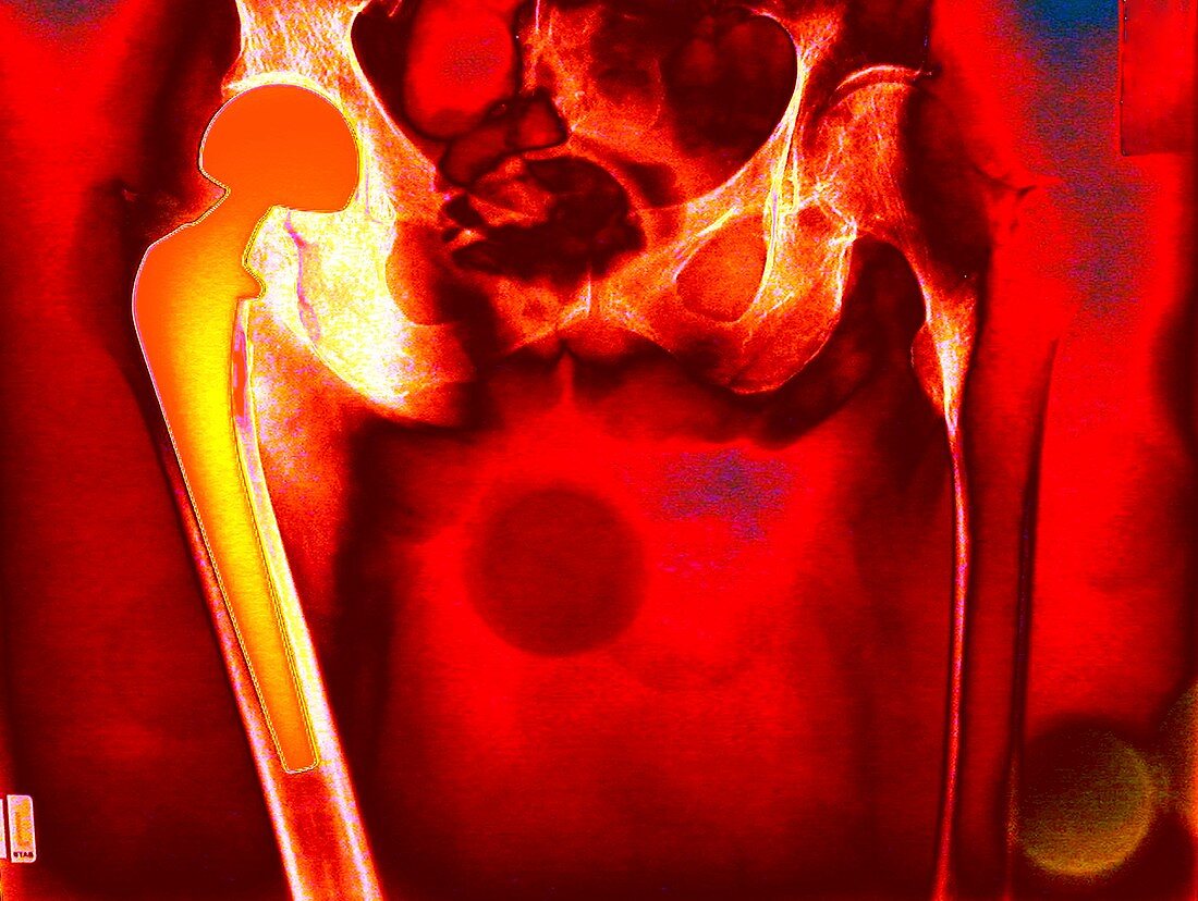 Hip replacement,coloured X-ray