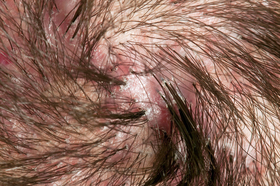 Folliculitis of the scalp