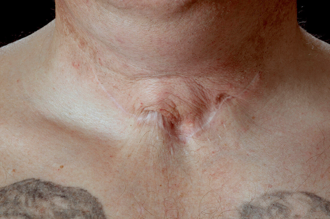 Scar revision before surgery