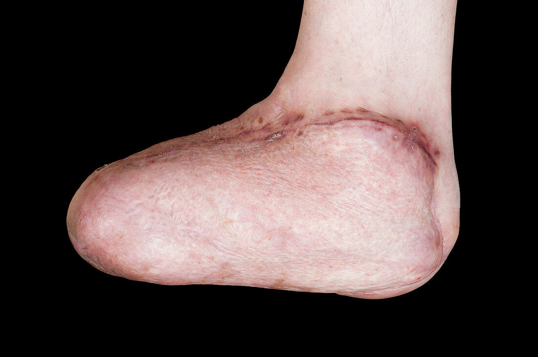 Foot reconstruction after toe amputations