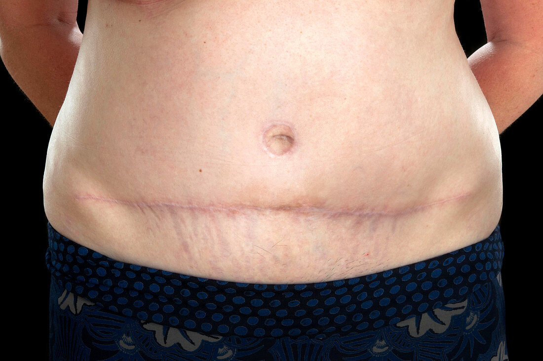 Breast reconstruction scar