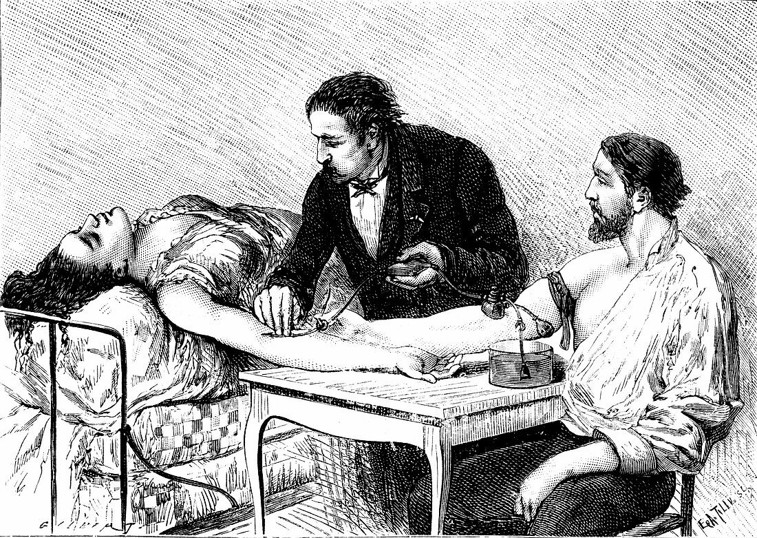 Direct blood transfusion,1882
