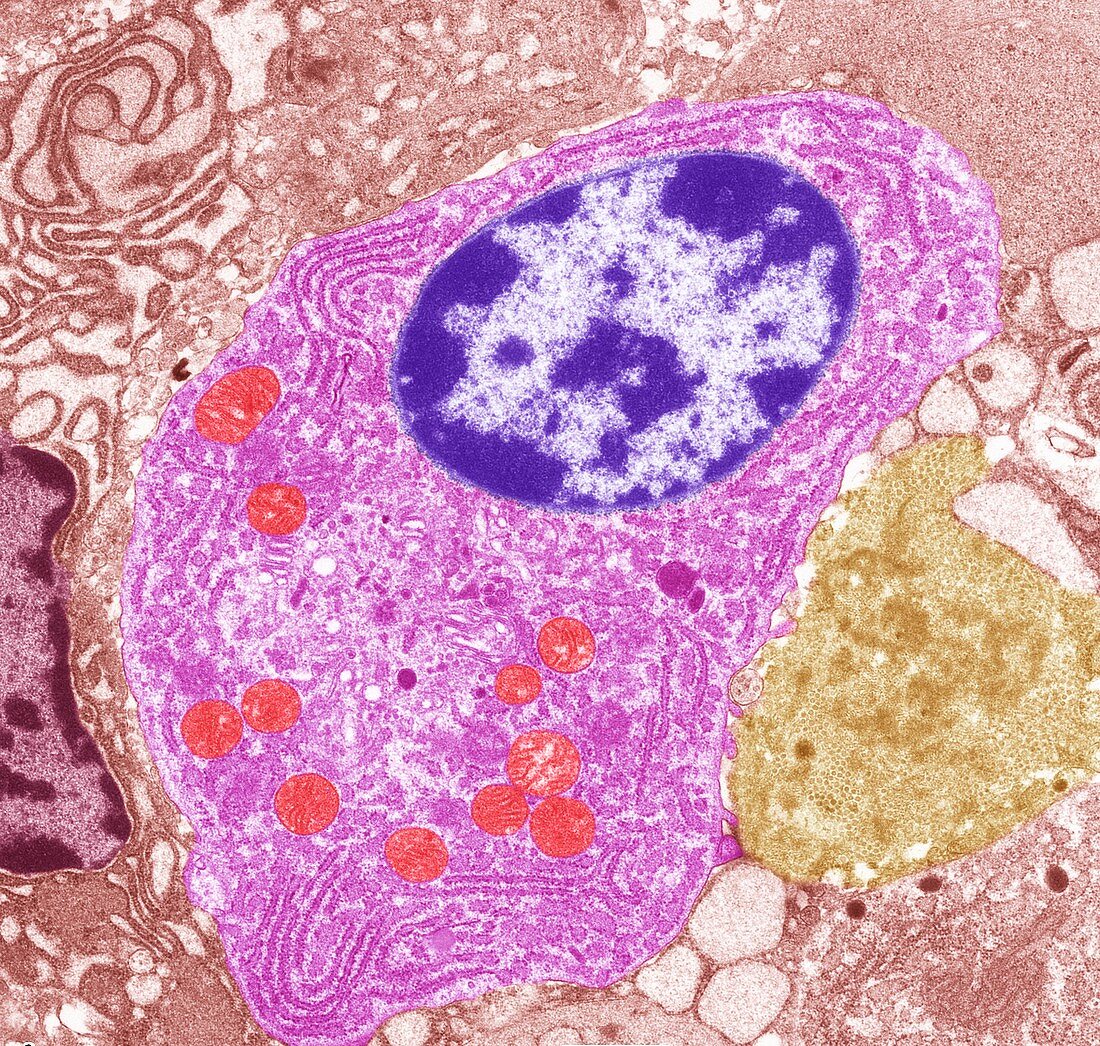 Thyroid cancer cell,TEM