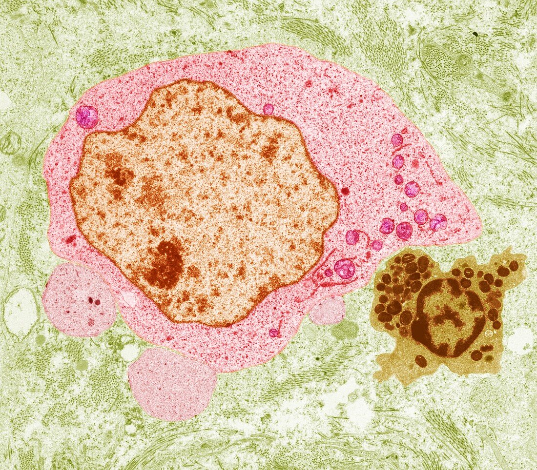 Seminoma cancer cell,TEM