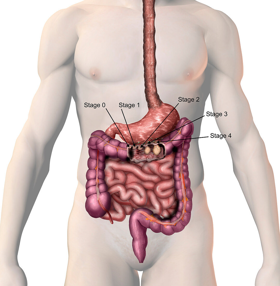 Colon Cancer,illustration