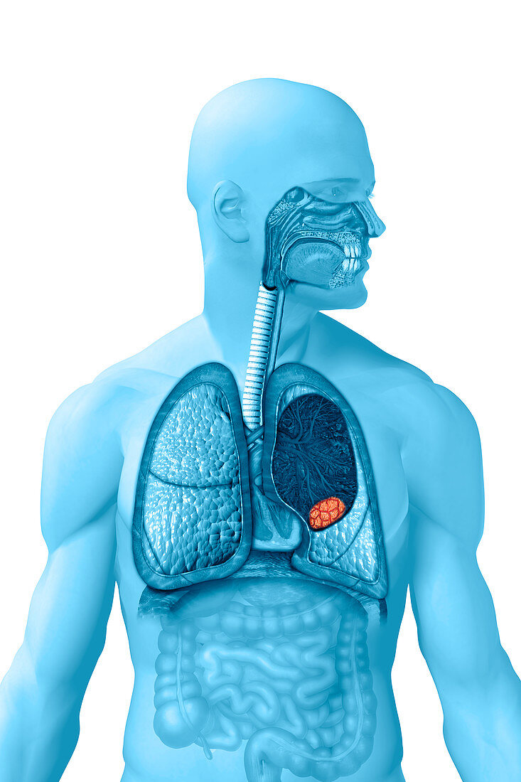 Lung Cancer,illustration
